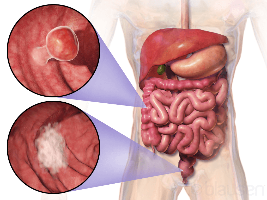 Colorectal cancer medical condition