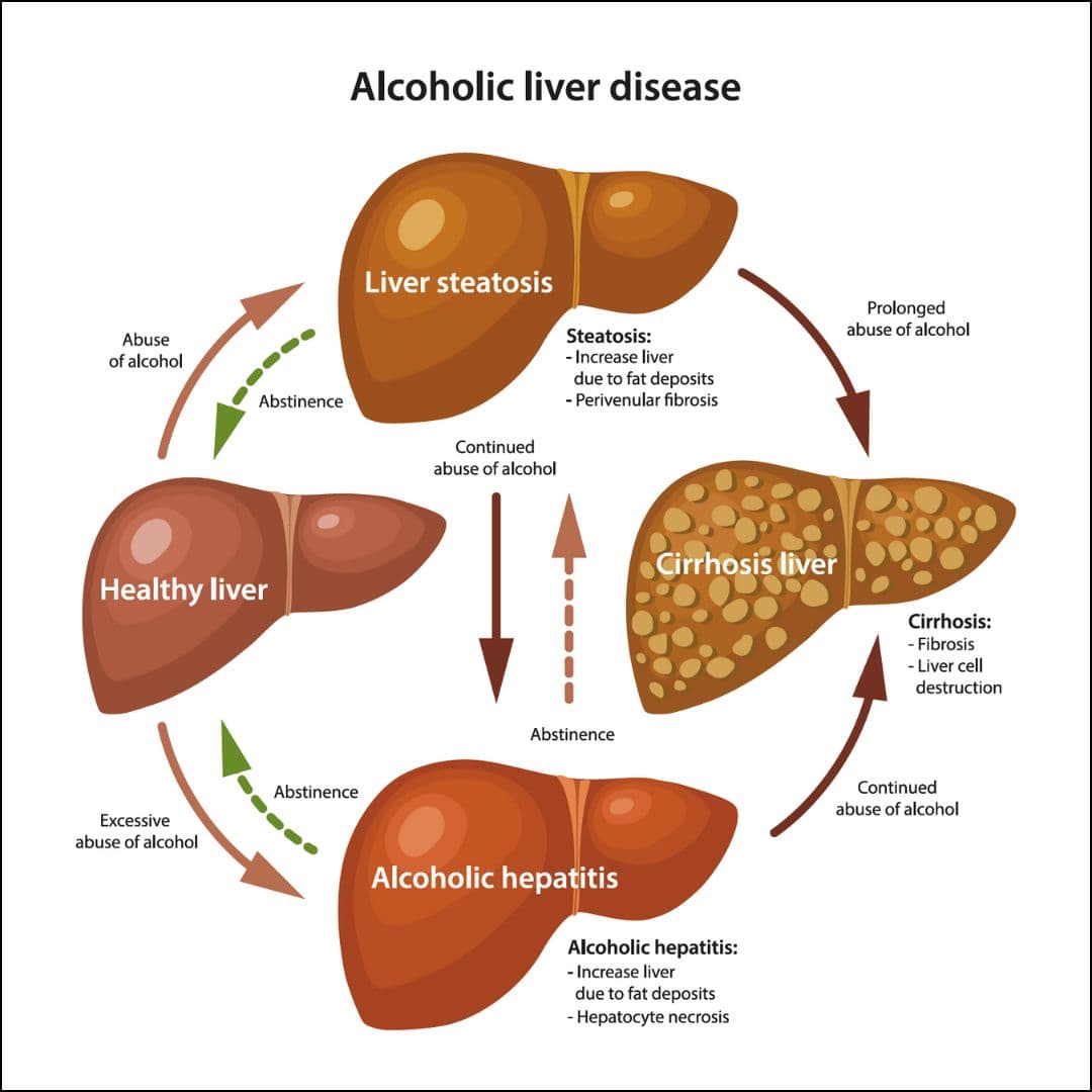Alcoholic Liver Disease medical condition