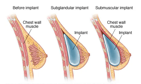Breast augmentation medical condition