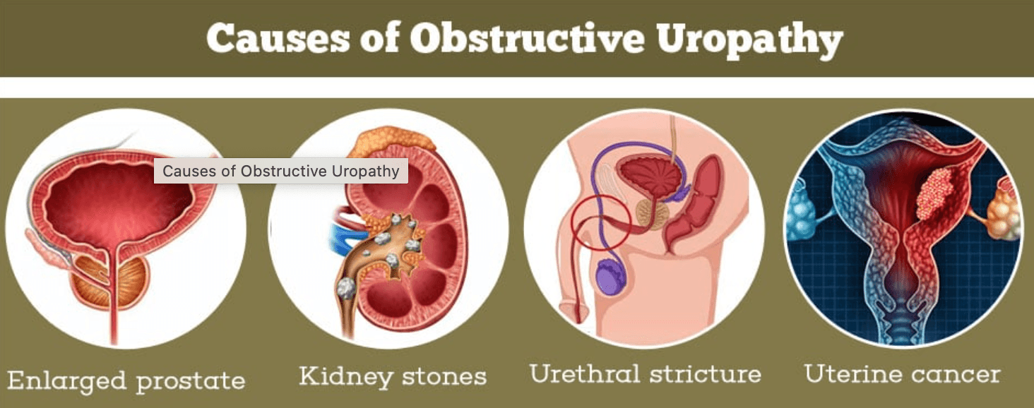 Obstructive Uropathy medical condition