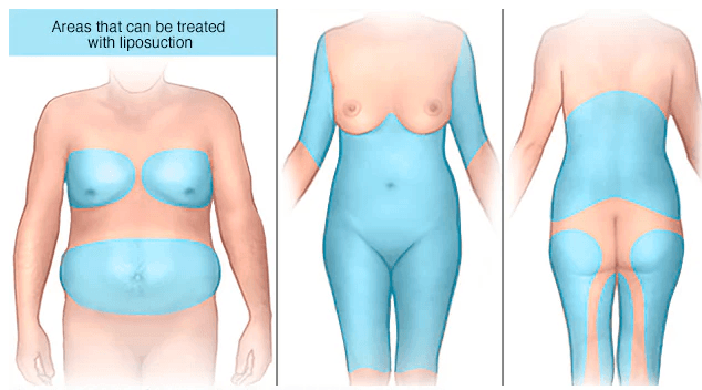 Liposuction medical condition