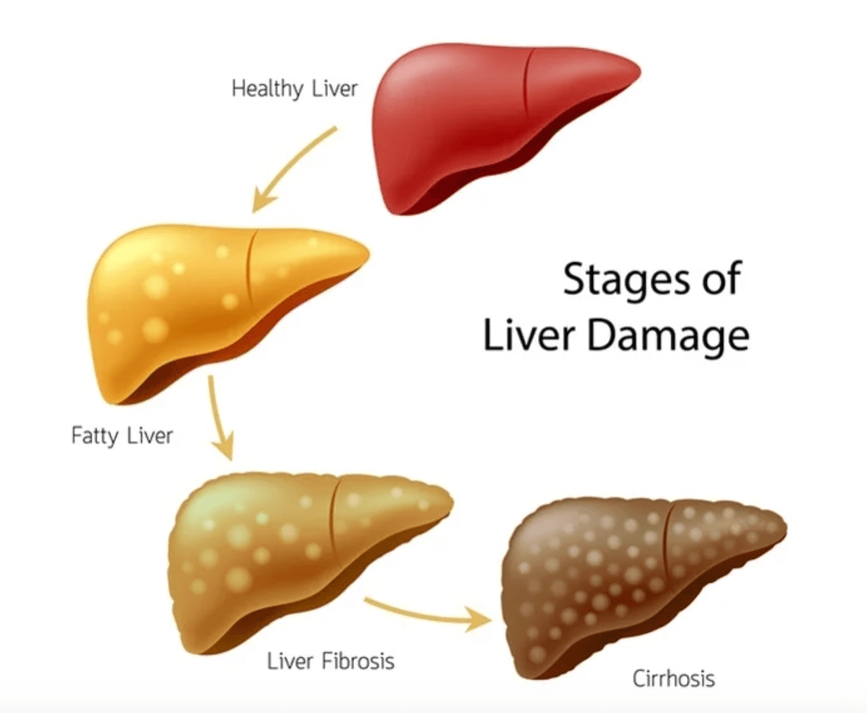 Cirrhosis medical condition