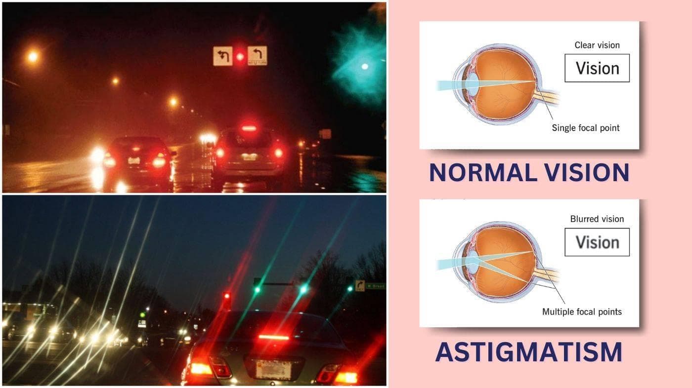 Astigmatism medical condition