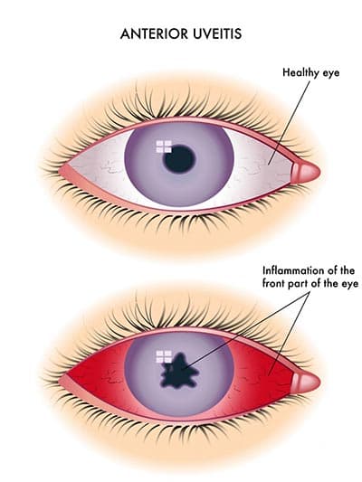 Eye inflammation medical condition