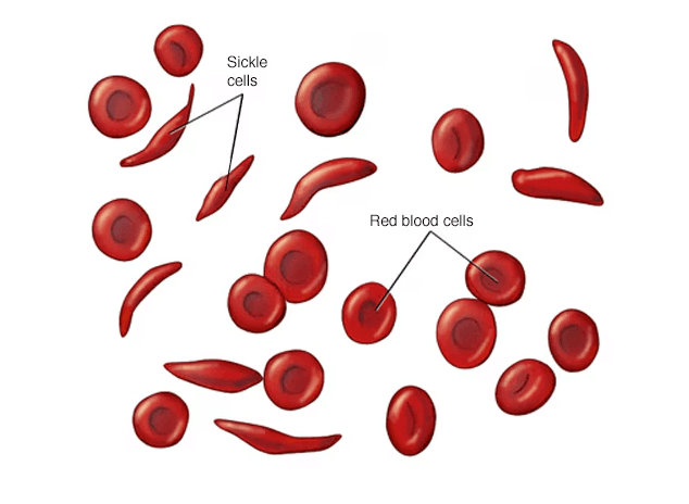 Sickle Cell Disease medical condition