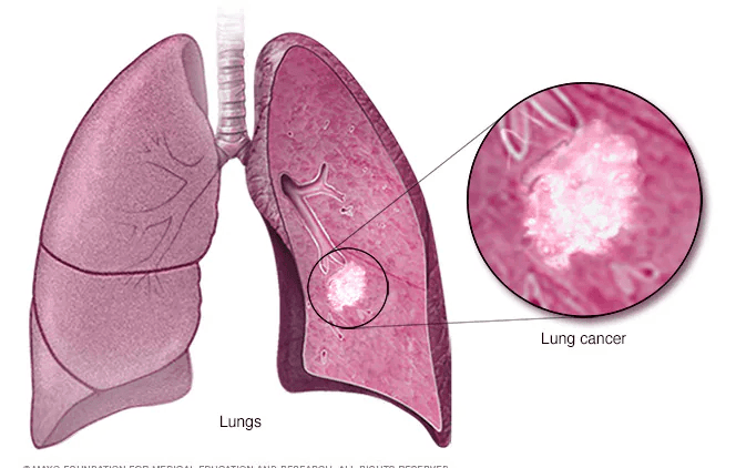 Lung Cancer medical condition