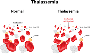 Thalassemia medical condition