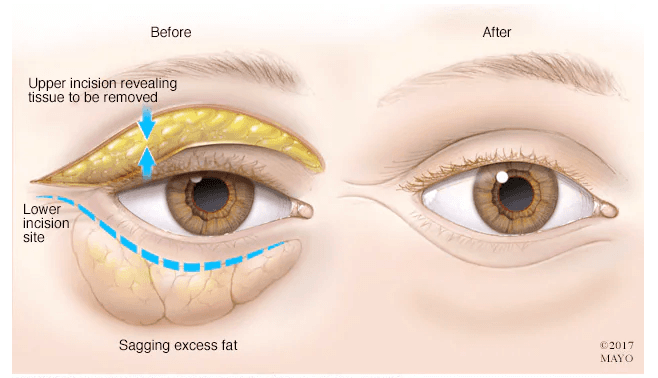 Blepharoplasty medical condition