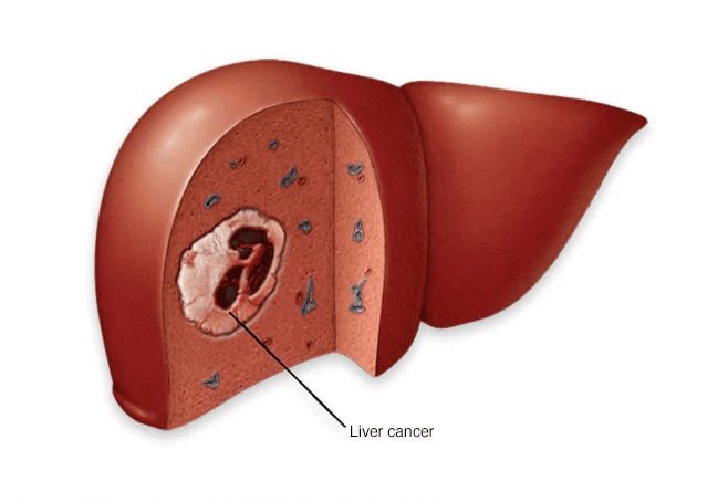 Liver Cancer medical condition