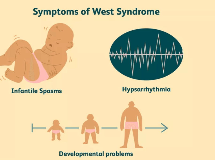 West syndrome medical condition
