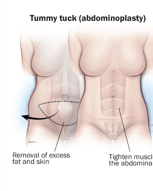Abdominoplasty (tummy tuck) medical condition