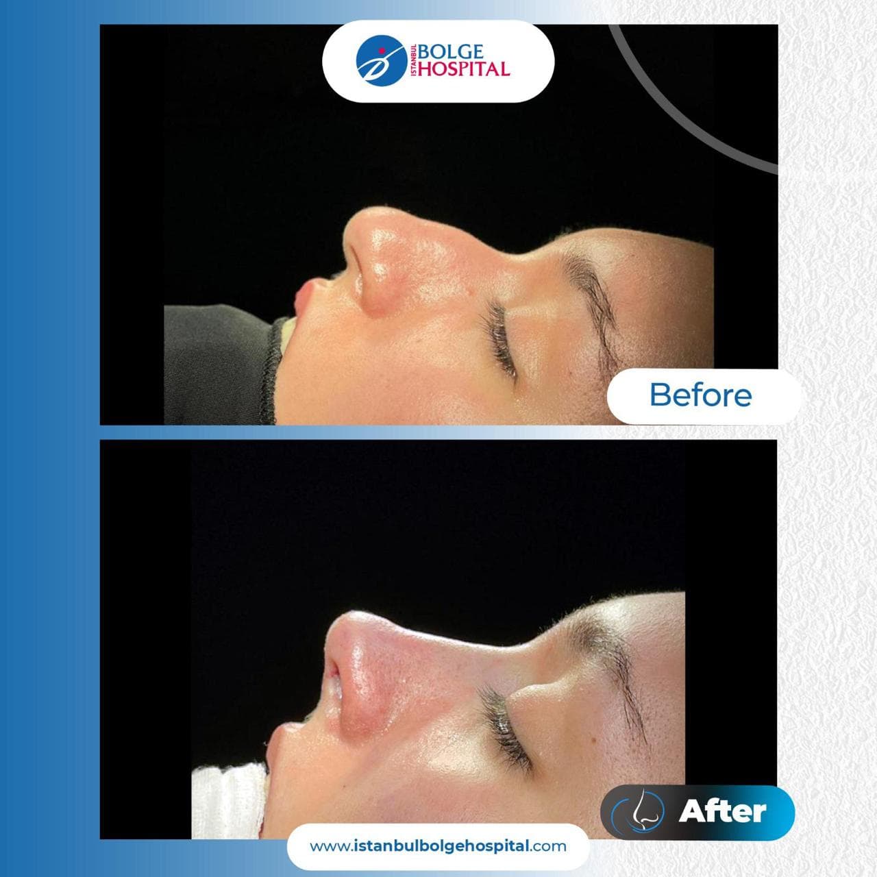 Rhinoplasty medical condition