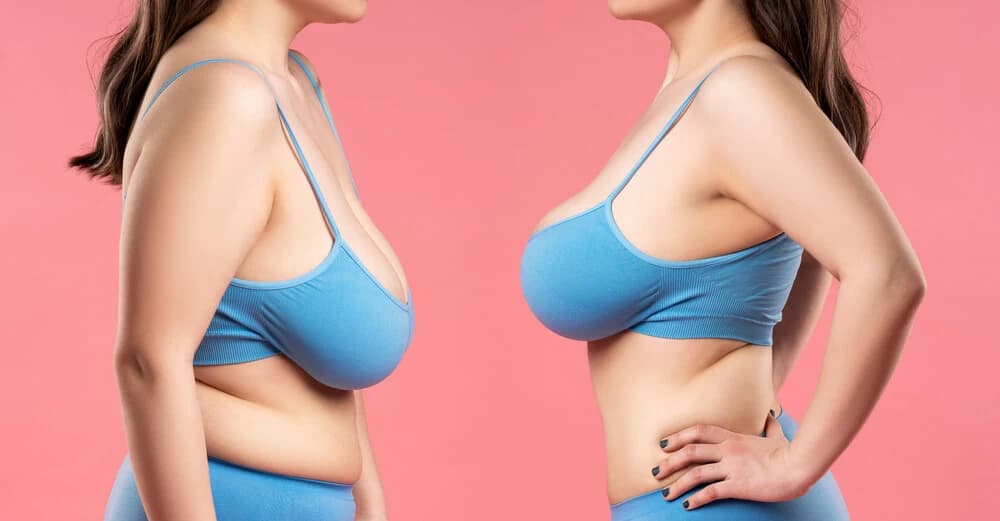 Breast reduction medical condition
