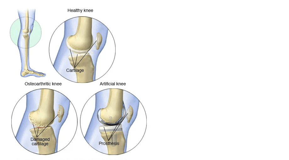 Knee replacement medical condition