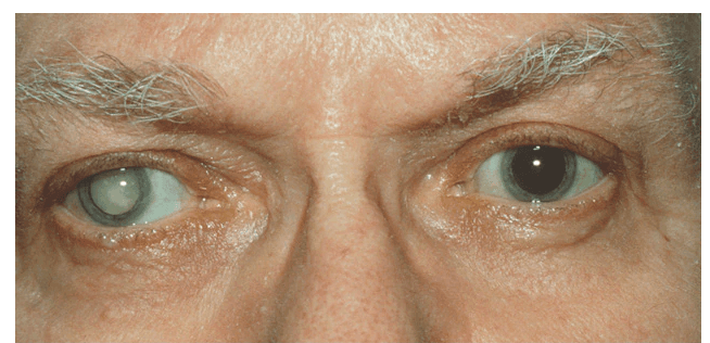 Cataracts medical condition