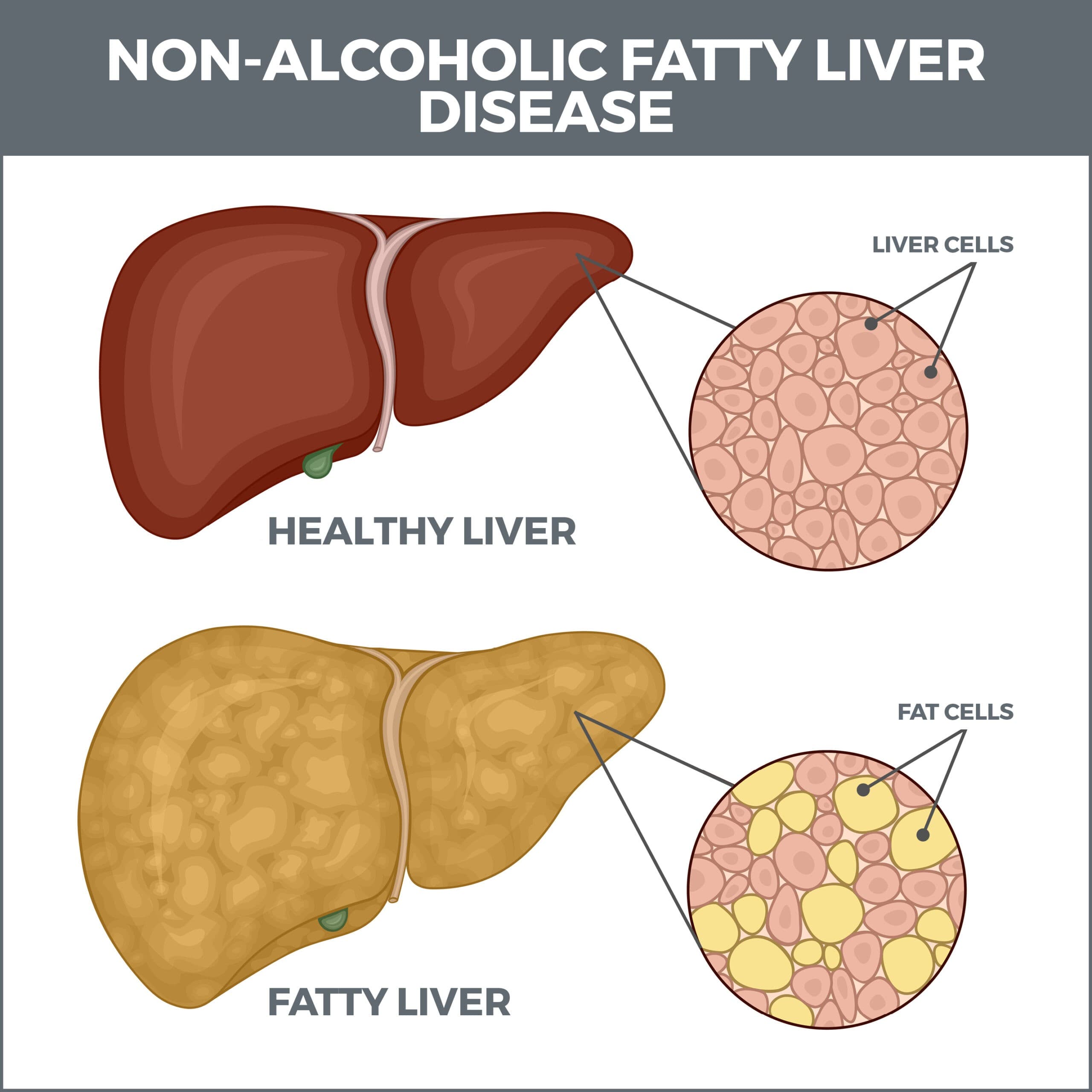 Non-alcoholic steatohepatitis (NASH) medical condition