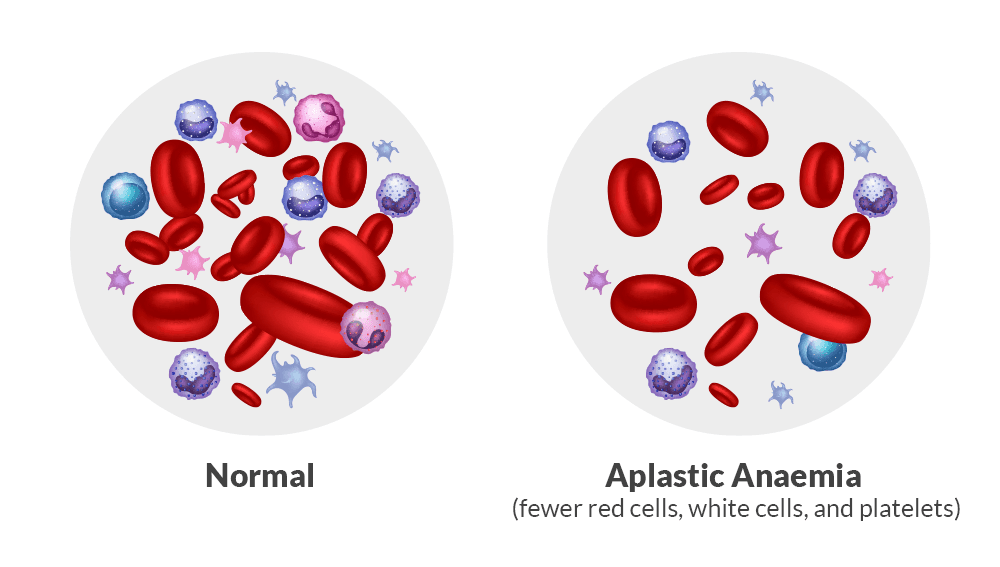 Aplastic Anemia medical condition