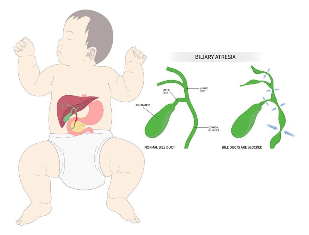 Biliary atresia medical condition