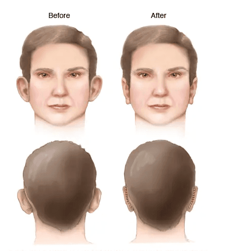 Otoplasty medical condition