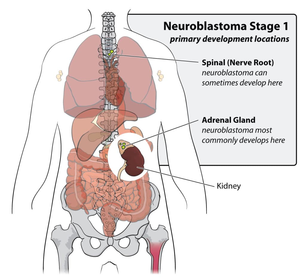 Neuroblastoma medical condition