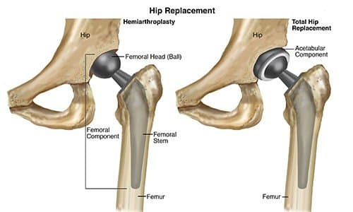 Total Hip Replacement medical condition