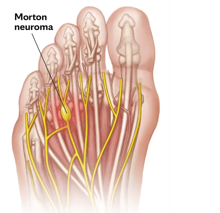 Morton’s neuroma medical condition