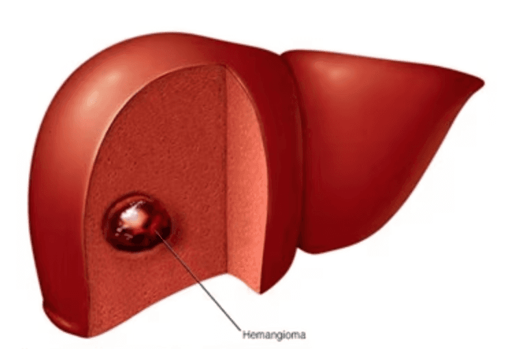 Liver hemangioma medical condition