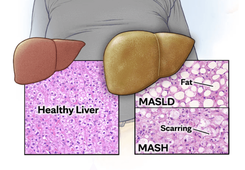 Fatty liver disease (MASLD) medical condition