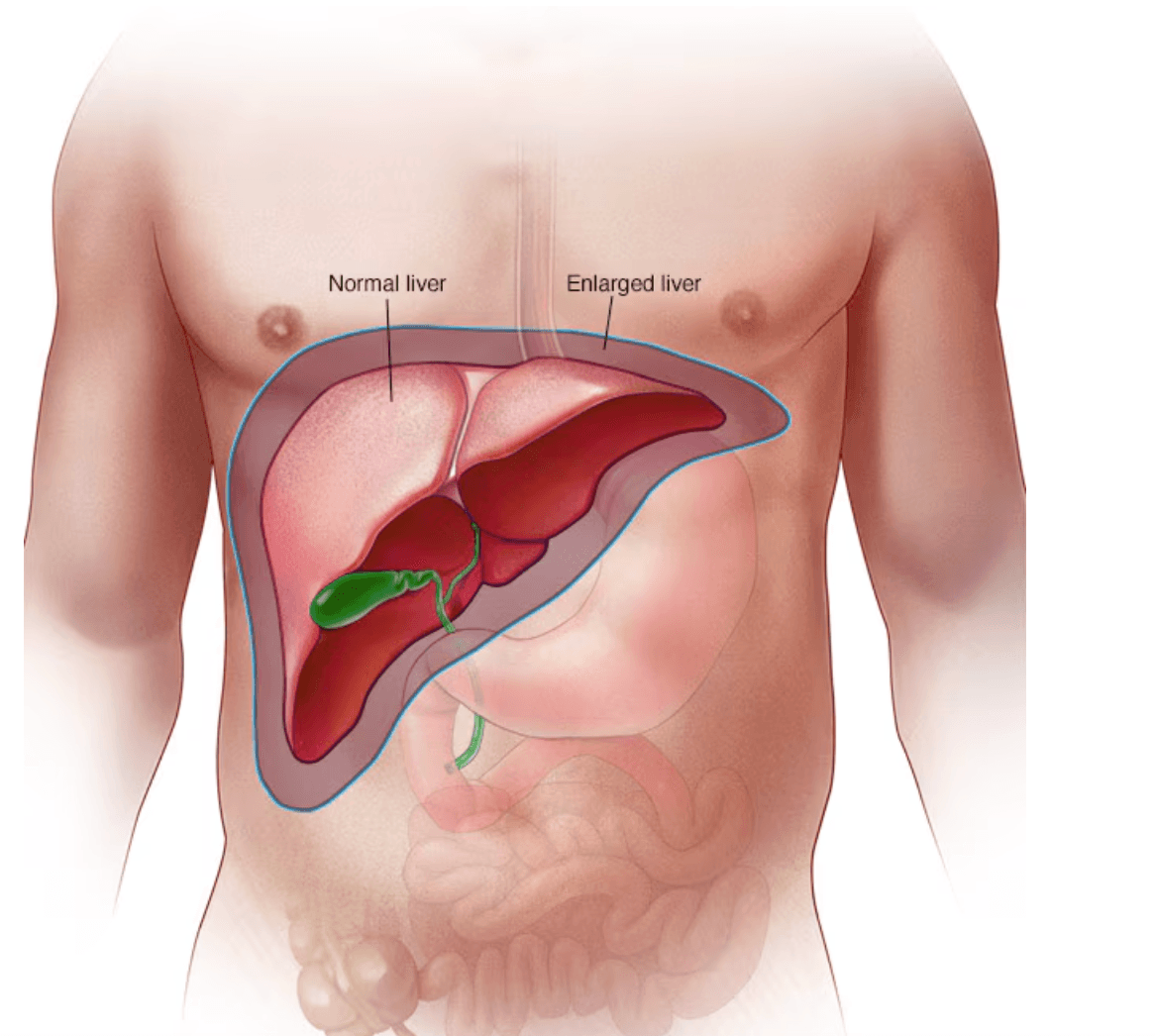 Enlarged liver medical condition