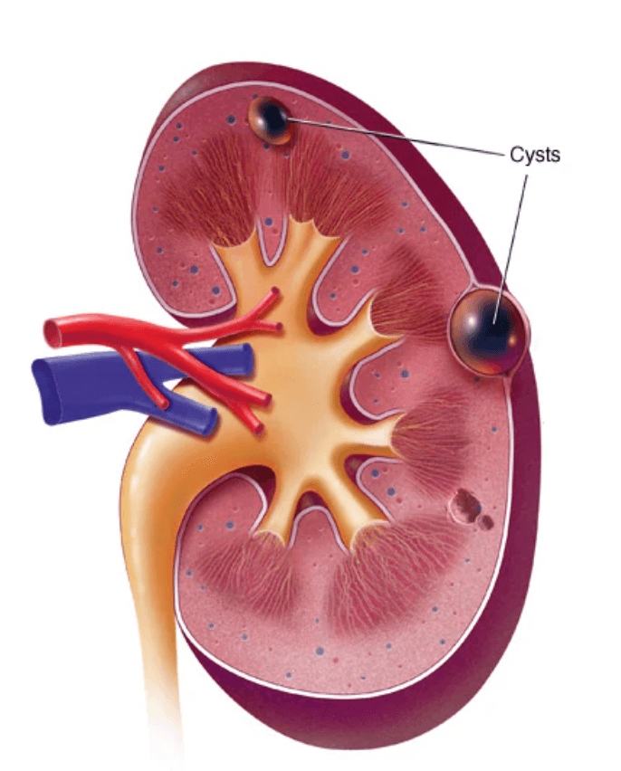 Kidney cysts medical condition