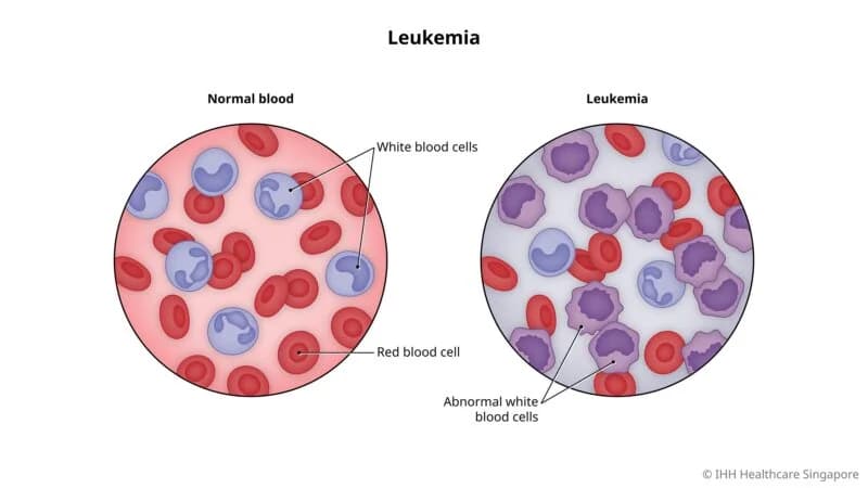 Acute Lymphocytic Leukemia (ALL) medical condition