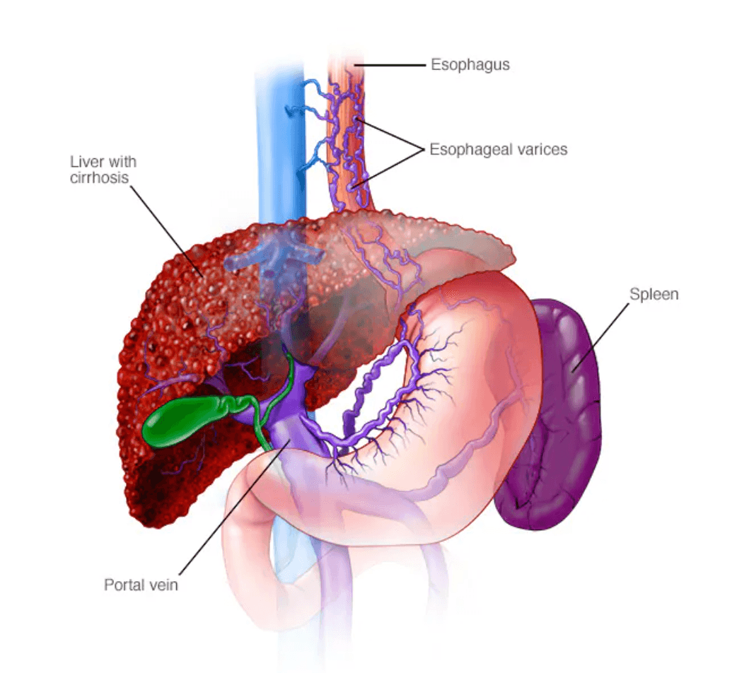 Esophageal varices medical condition