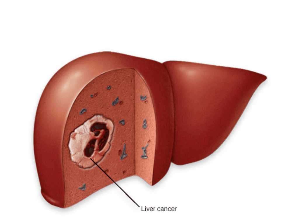 Hepatocellular carcinoma (HCC) medical condition