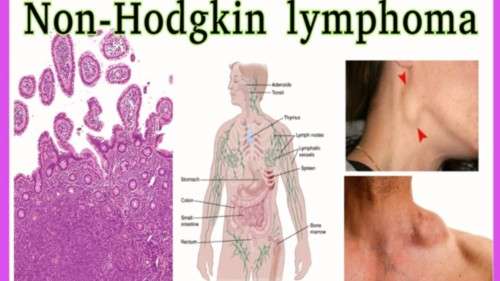 Non-Hodgkin lymphoma (NHL) medical condition