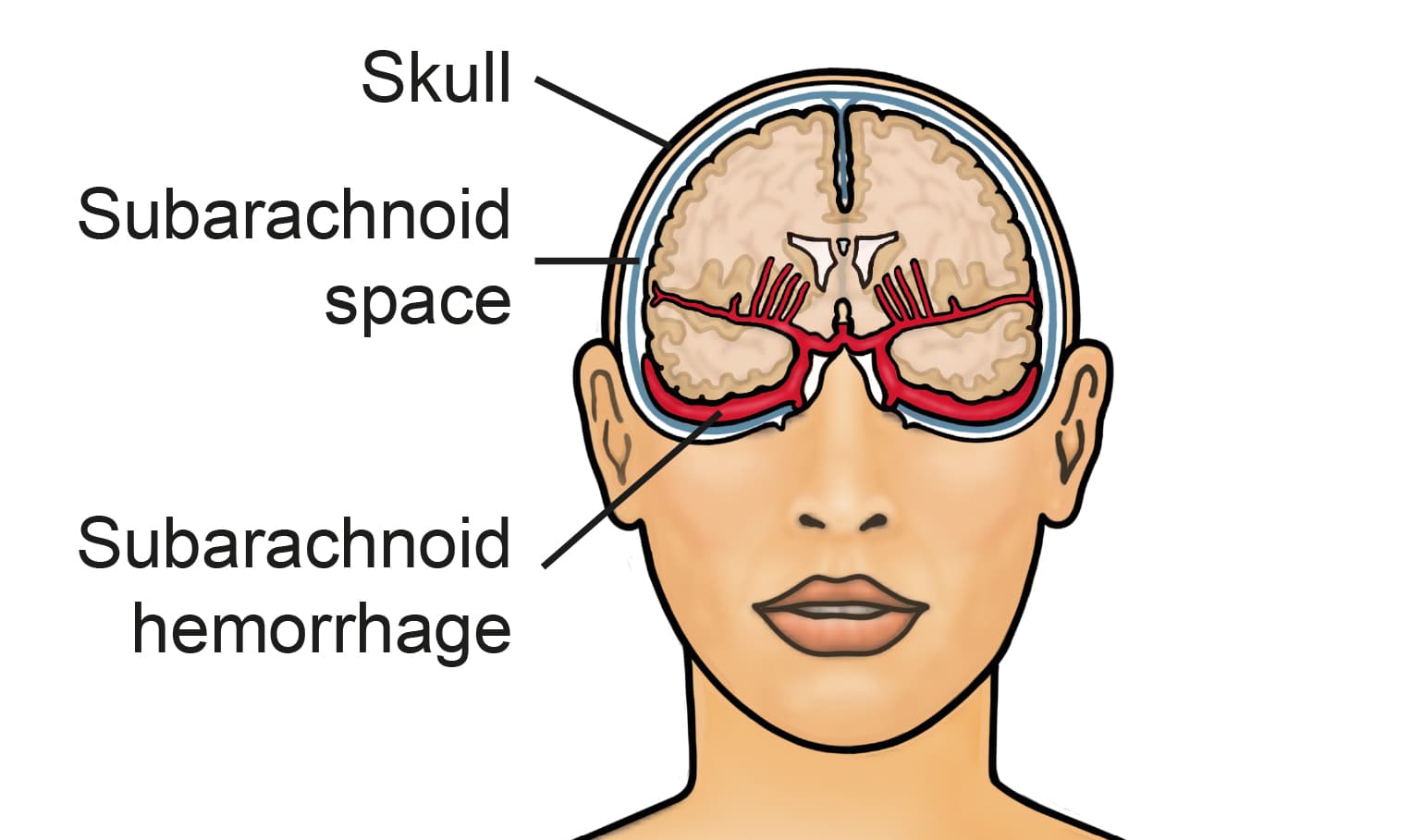 Subarachnoid Haemorrhage medical condition