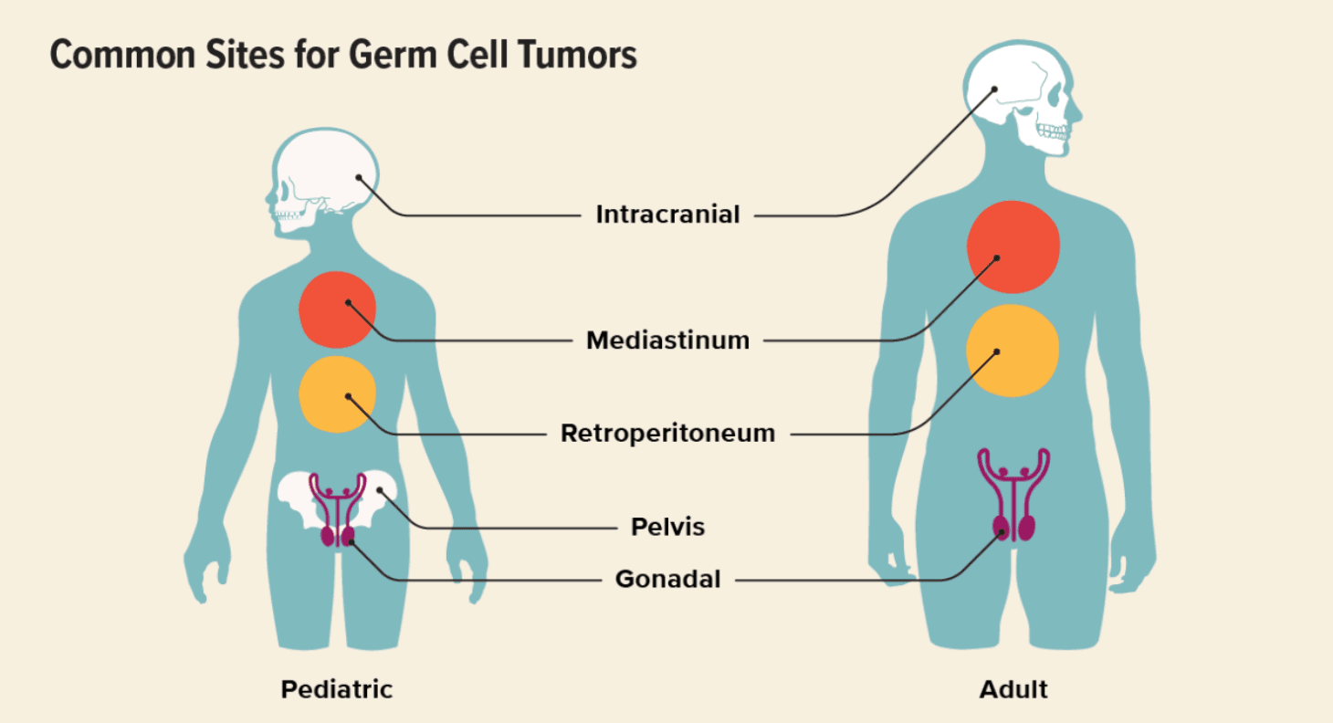 Germ Cell Tumor medical condition