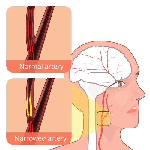 Carotid artery stenosis medical condition