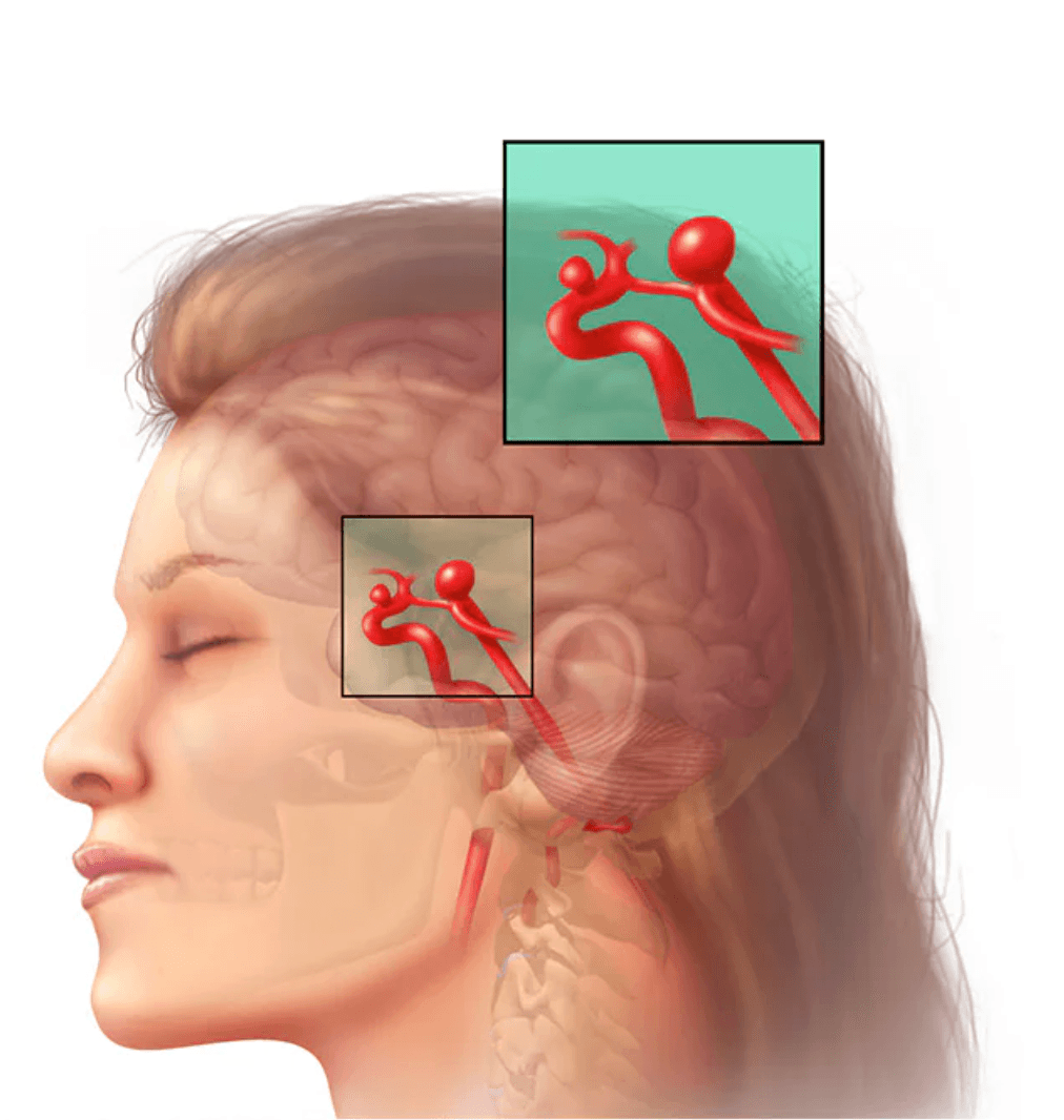 Brain aneurysm medical condition