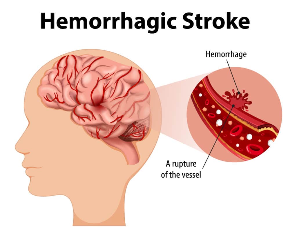 Haemorrhagic Stroke medical condition