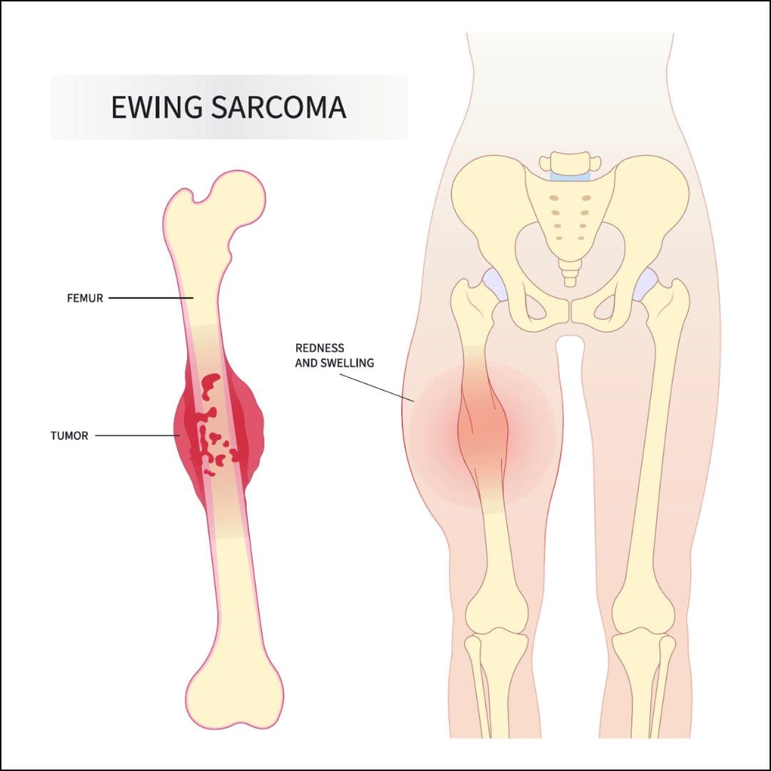Ewing Sarcoma (Ewing’s Sarcoma) medical condition