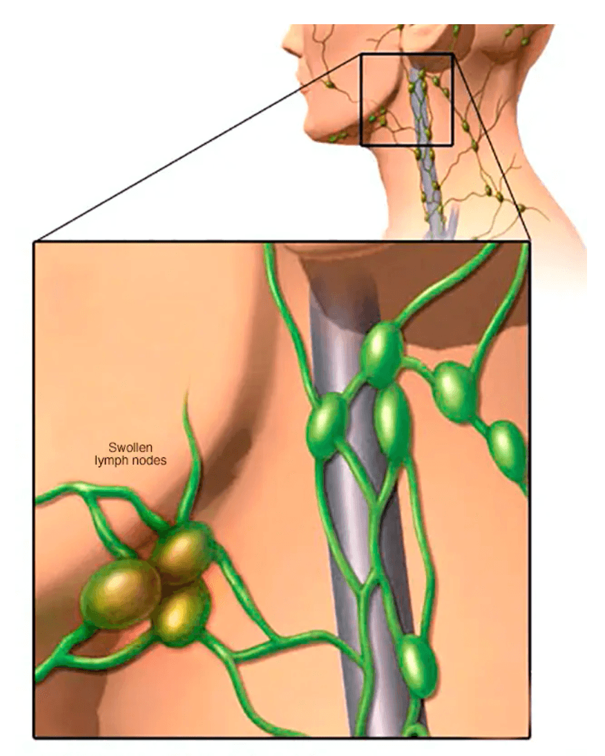 Hodgkin lymphoma (Hodgkin disease) medical condition