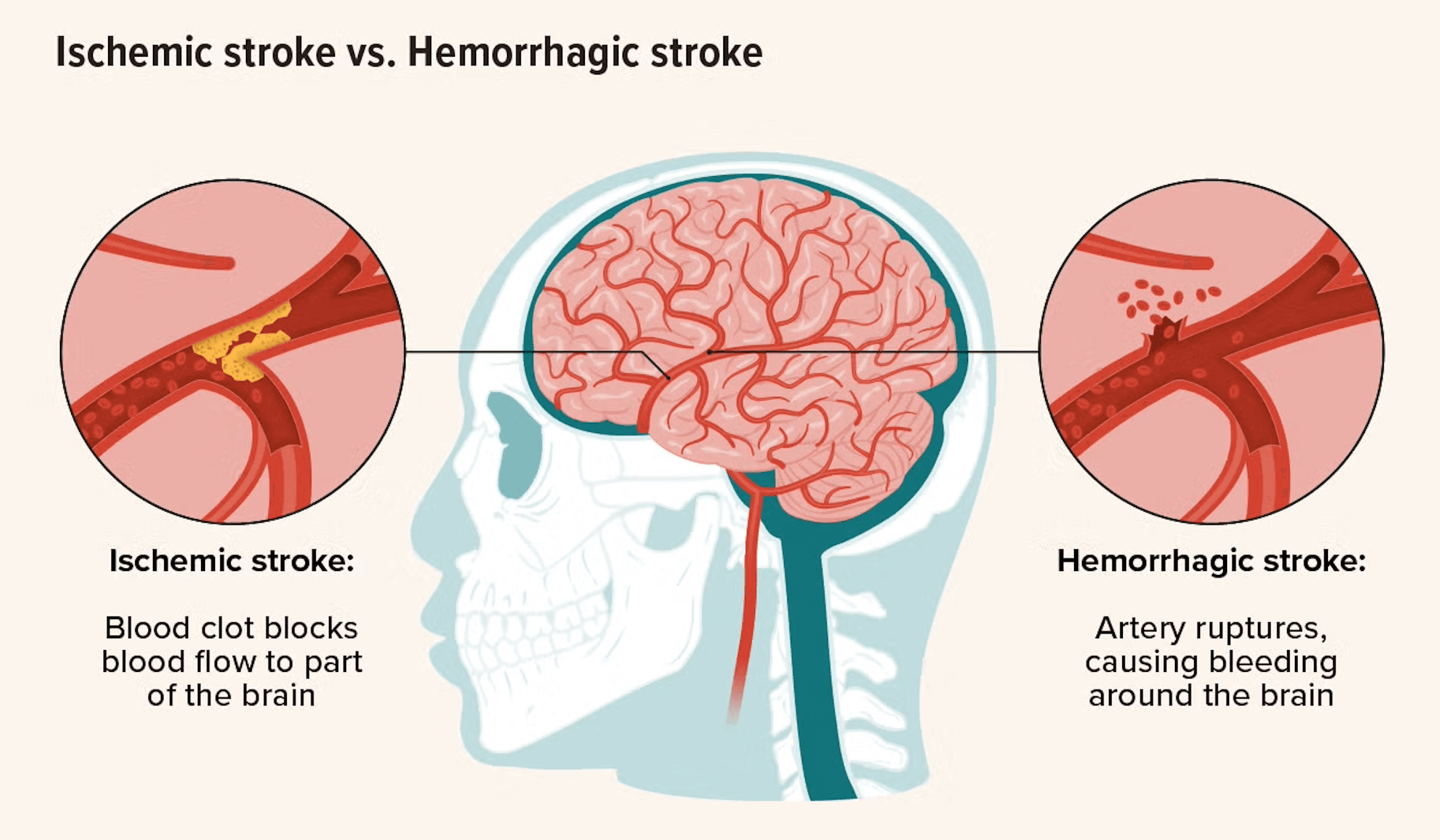 Ischaemic stroke medical condition