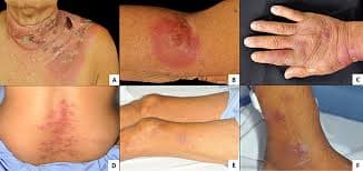 Acute Myeloid Leukemia (AML) in Children medical condition