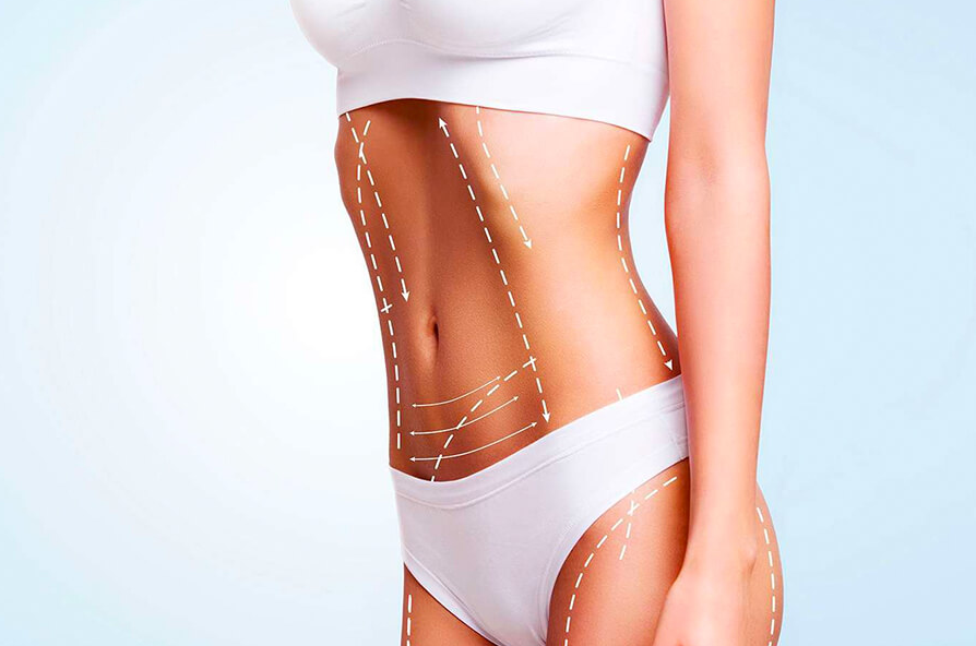 Liposuction in Turkey - Best Clinics, Costs and Packages related image