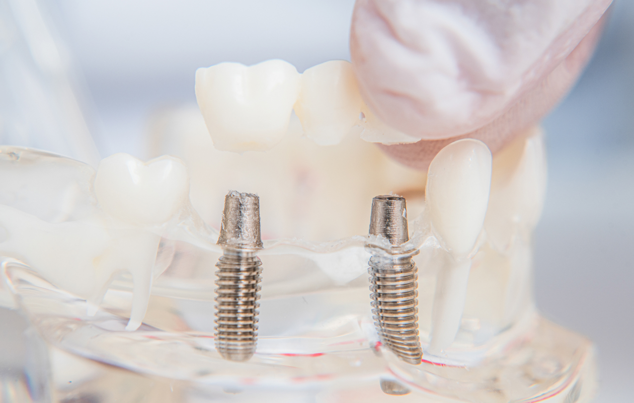 All-on-6 Dental Implants Poland related image
