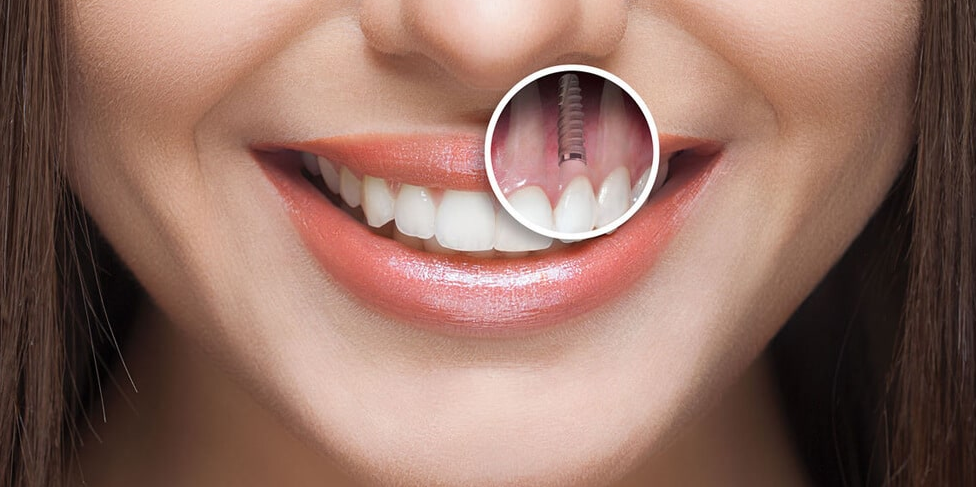 All-on-6 Dental Implants in Turkey related image