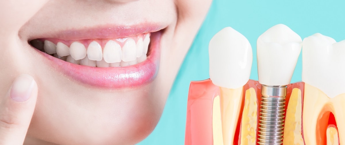 Full Mouth Dental Implants Turkey Package Deals related image