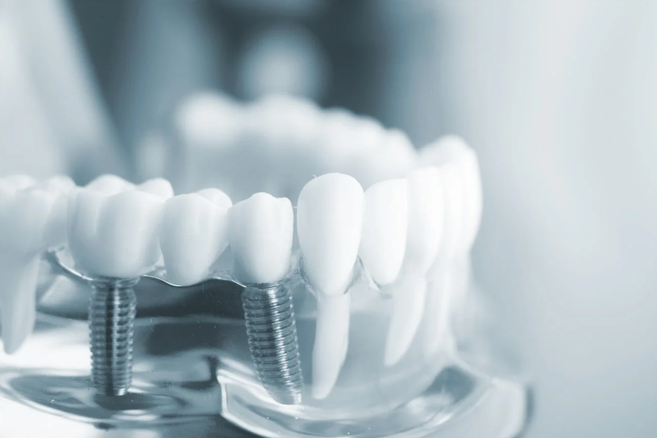 All-on-6 Dental Implants Poland related image