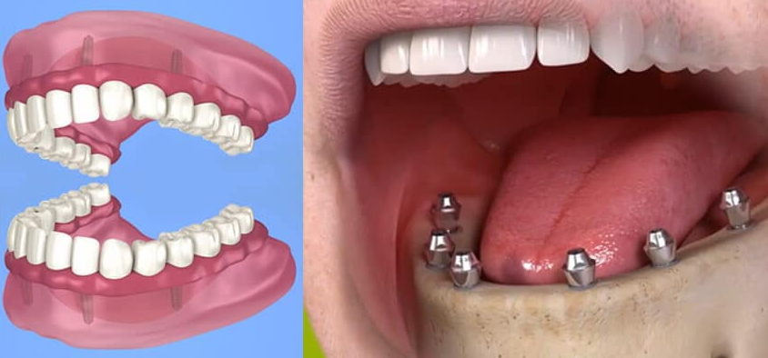 All-on-6 Dental Implants in Turkey related image