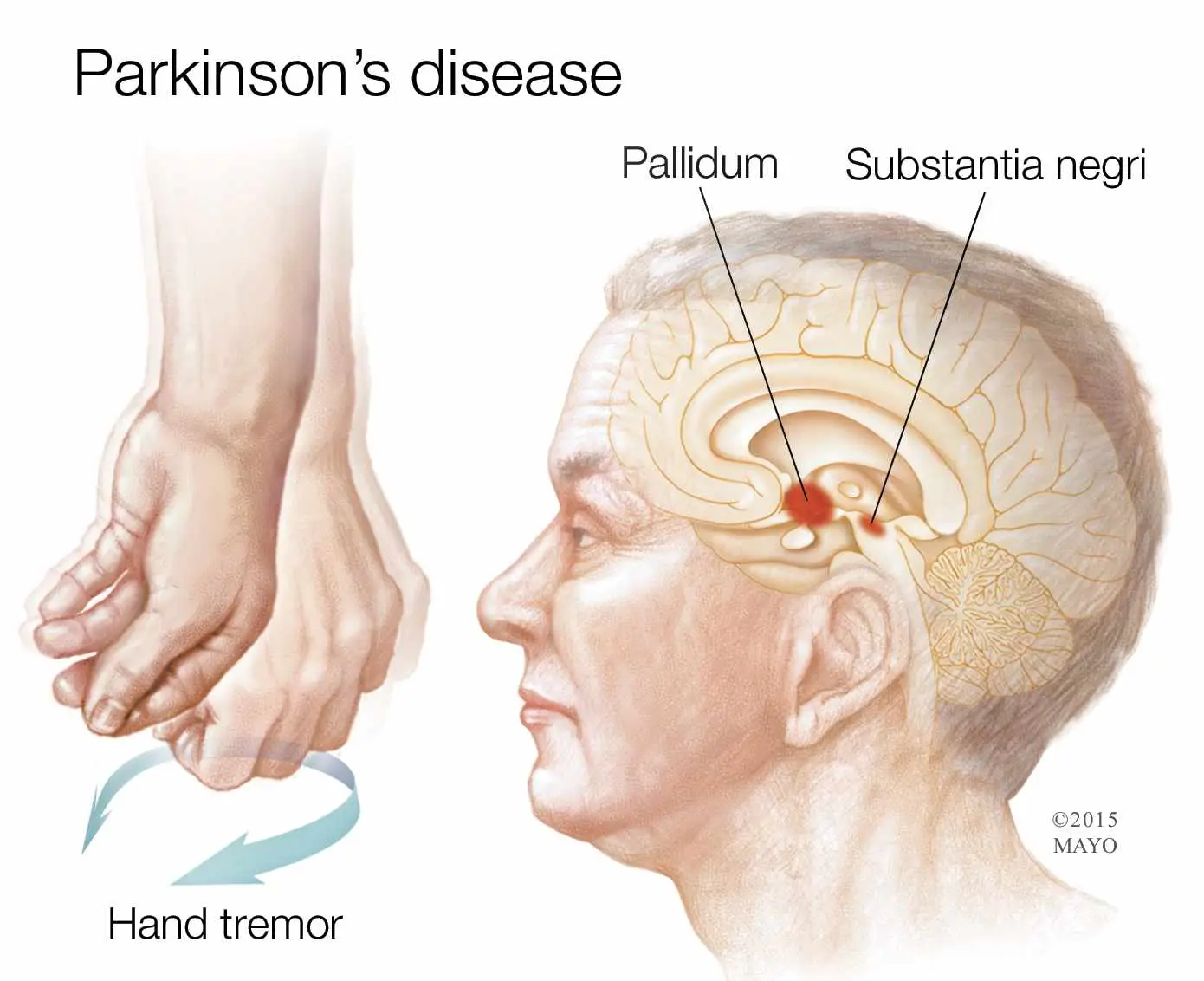 Parkinson's Treatment in Turkey - Best Clinics, Costs, Doctors related image